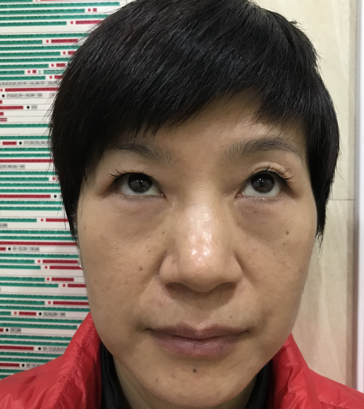 【去眼袋手术】眼袋膨出严重细纹滋长怎么办917 【去眼袋手术】眼袋膨出严重细纹滋长怎么办917