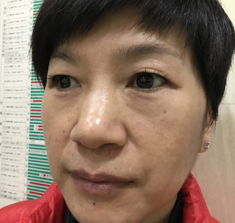 【去眼袋手术】眼袋膨出严重细纹滋长怎么办917 【去眼袋手术】眼袋膨出严重细纹滋长怎么办917