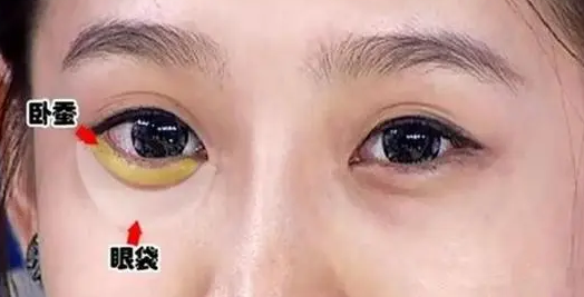 去眼袋手术