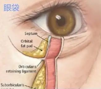 去眼袋手术