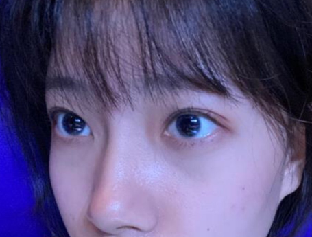 去眼袋手术