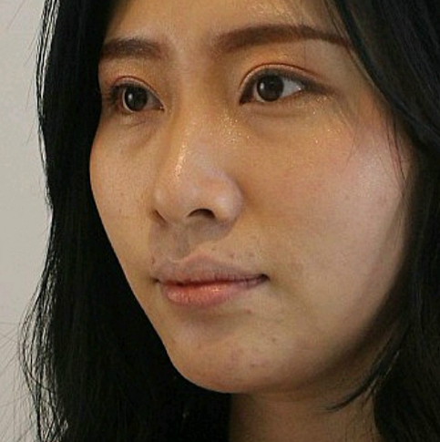 去眼袋手术