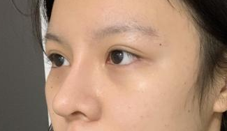 去眼袋手术