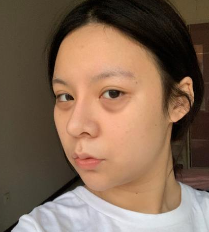 去眼袋手术