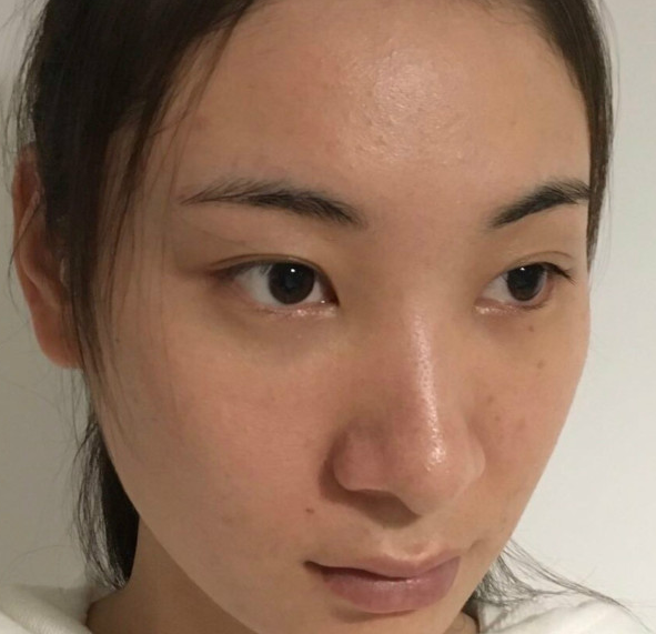 去眼袋手术
