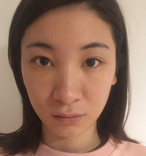 去眼袋手术