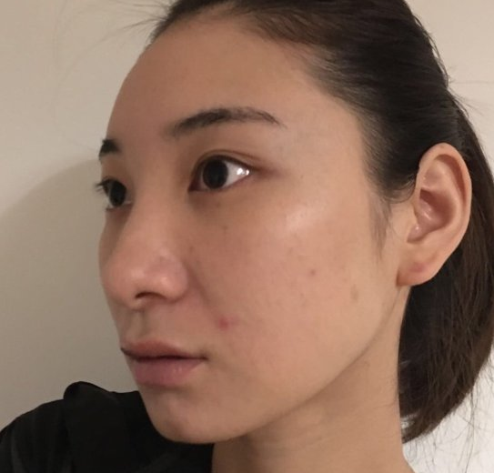 去眼袋手术