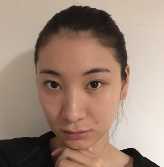 去眼袋手术