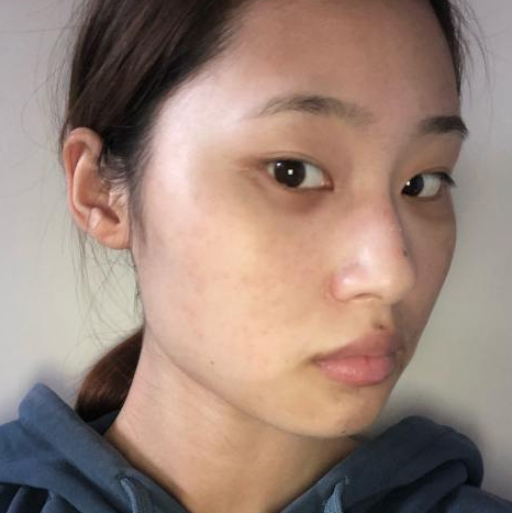 去眼袋手术