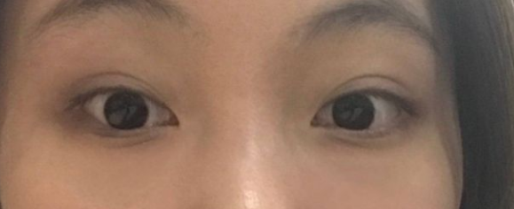 去眼袋手术