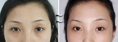 去眼袋手术
