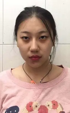 去眼袋手术