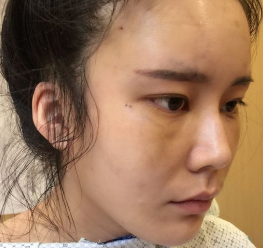 去眼袋手术