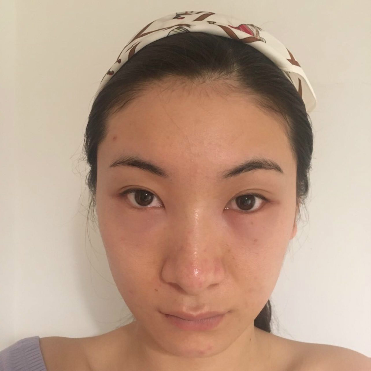 去眼袋手术