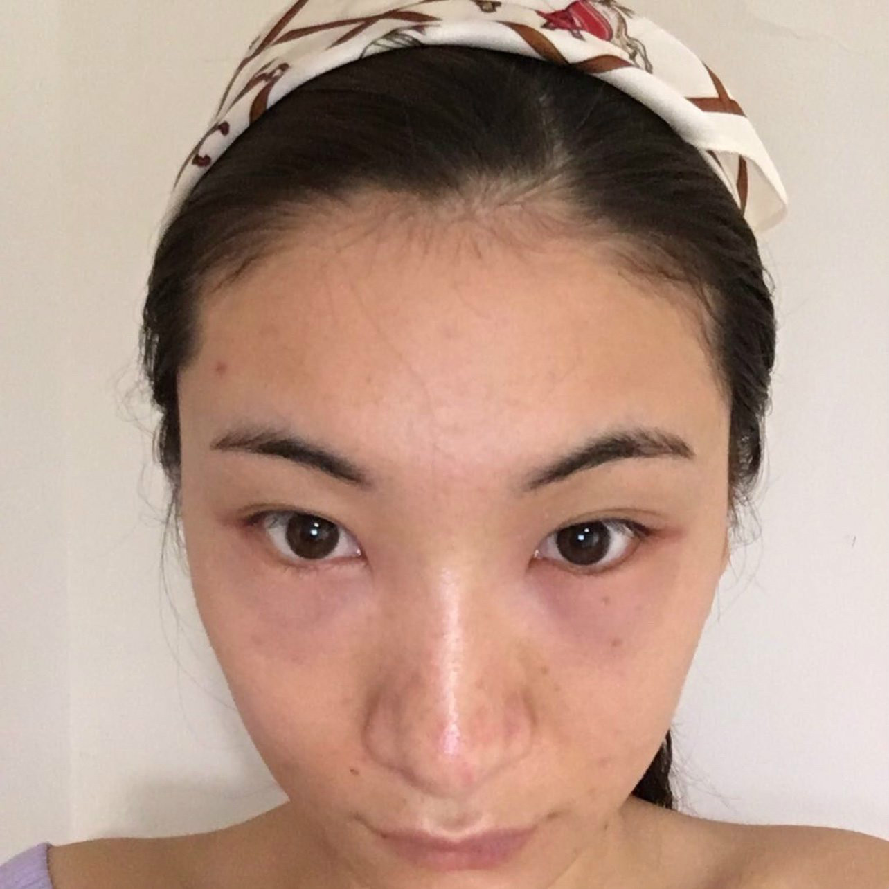 去眼袋手术