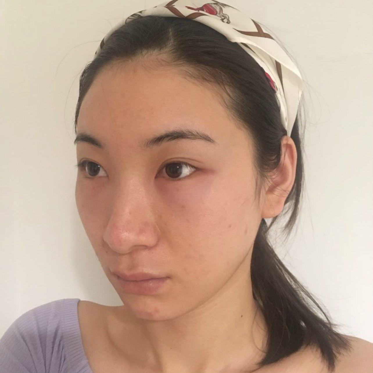 去眼袋手术