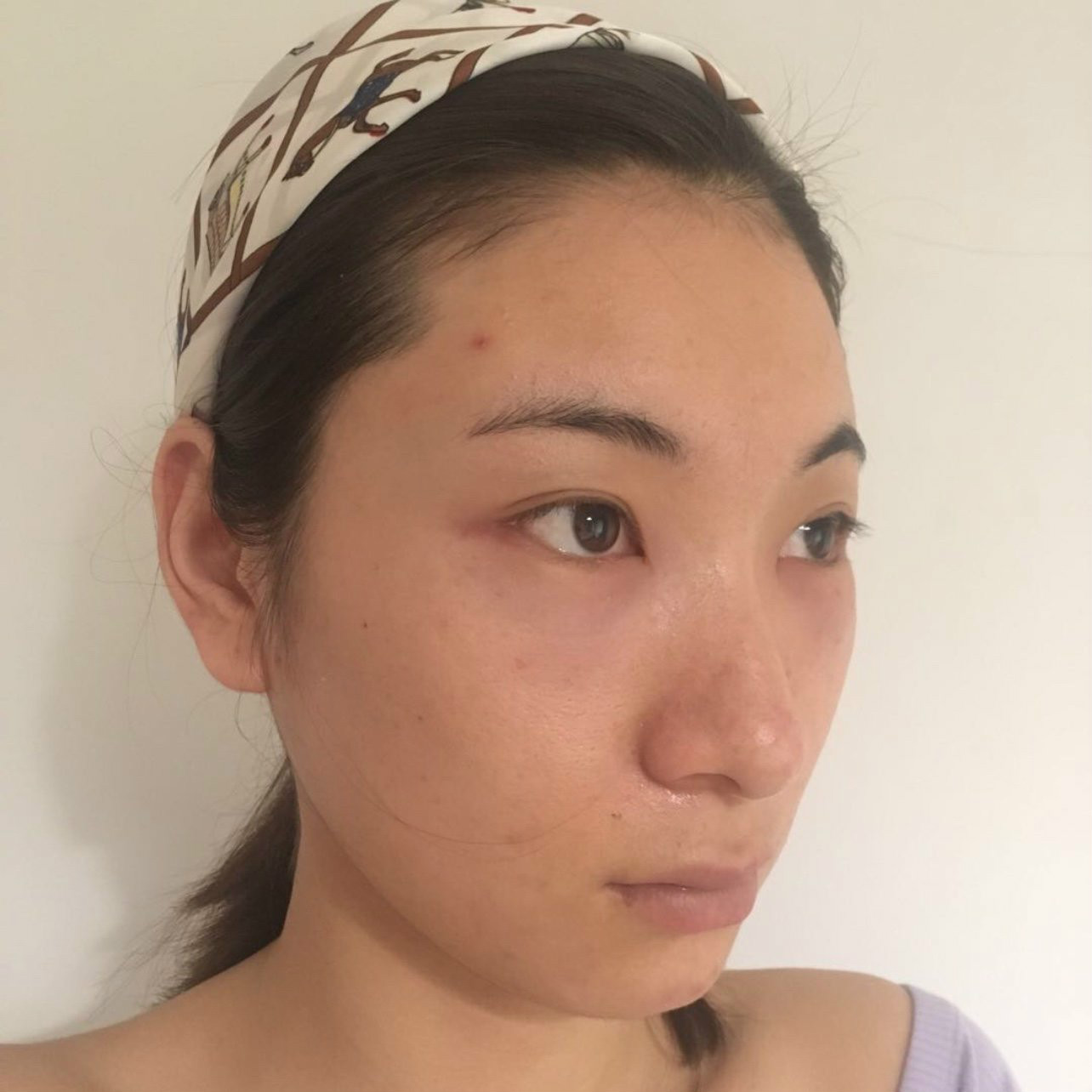 去眼袋手术