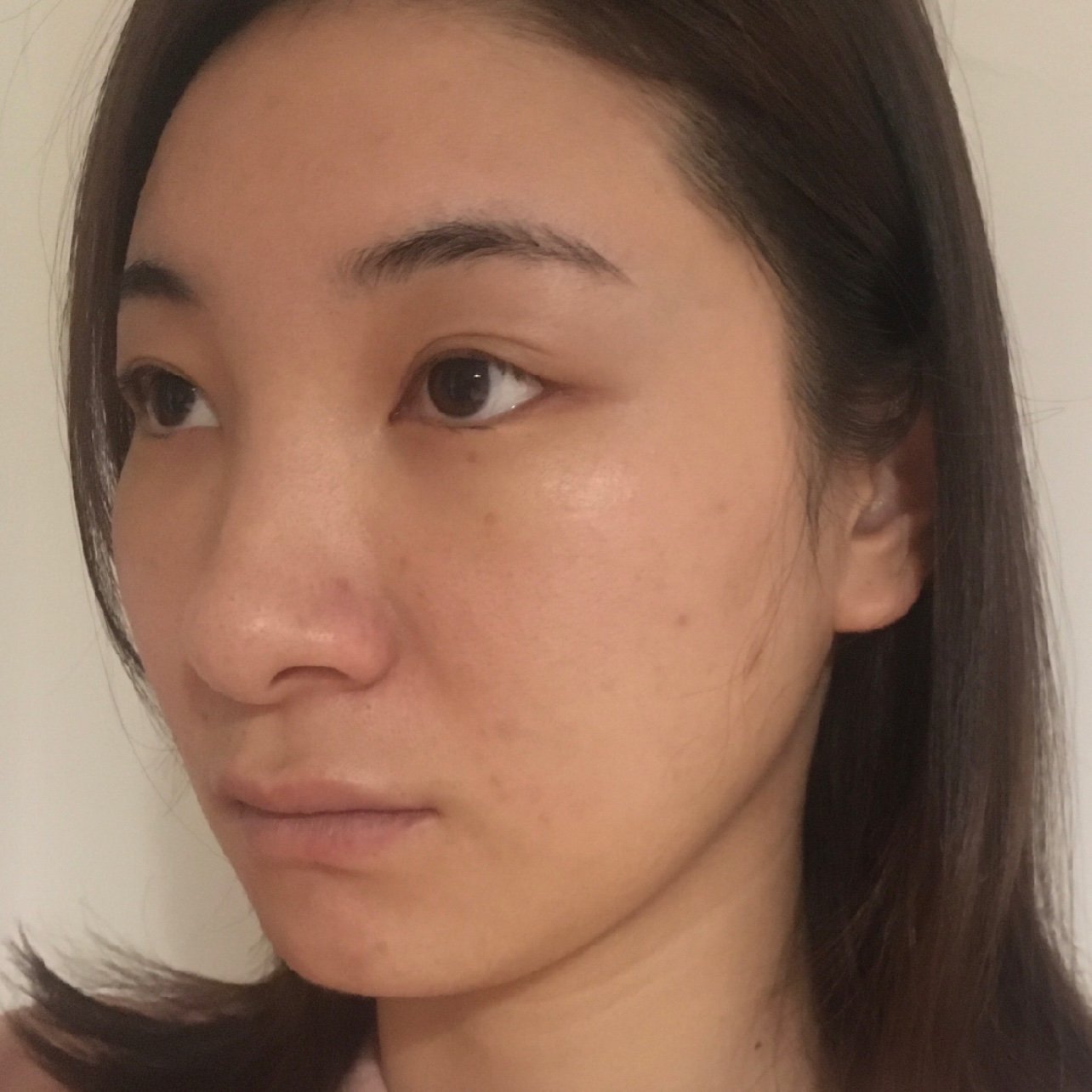 去眼袋手术