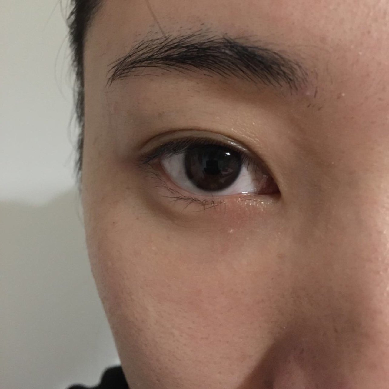 去眼袋手术