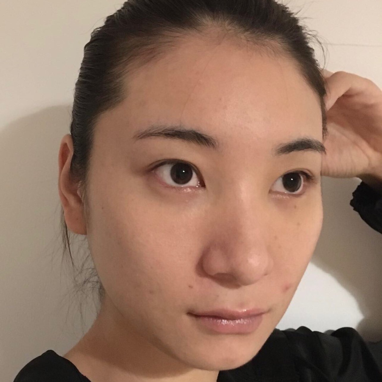 去眼袋手术