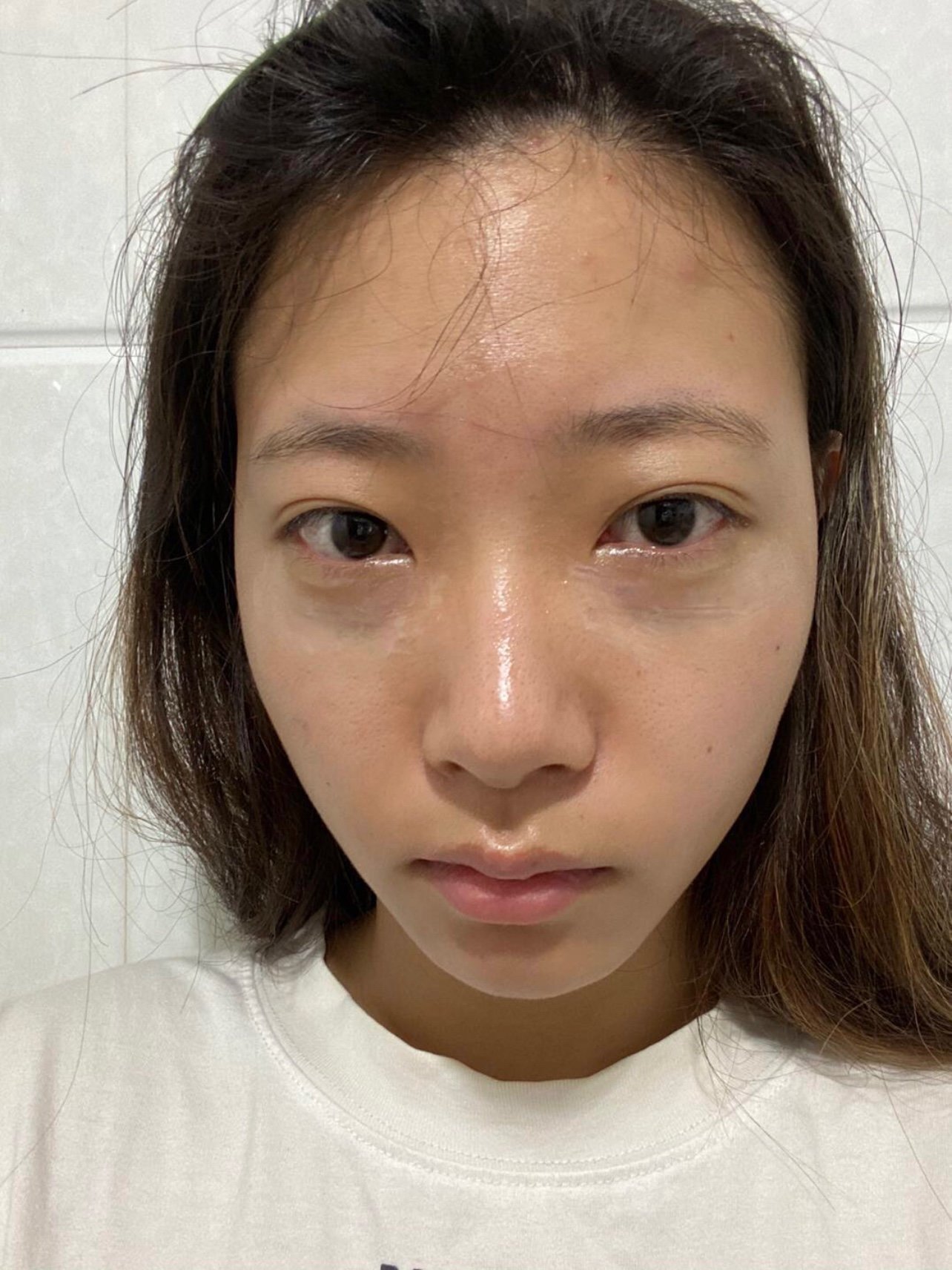 去眼袋手术