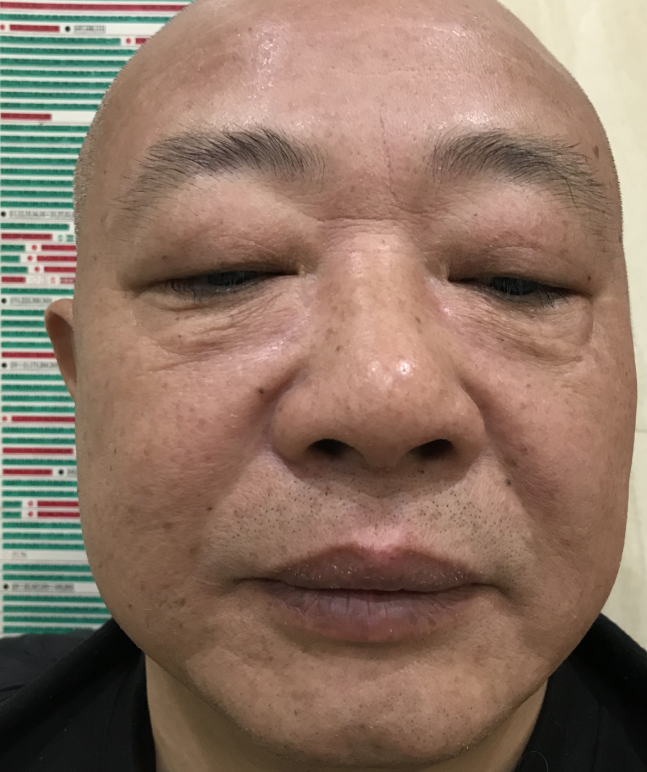 男士做去眼袋手术怎么样?要多久恢复?701 男士做去眼袋手术怎么样?要多久恢复?701