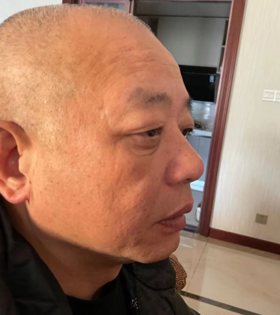 男士做去眼袋手术怎么样?要多久恢复?701 男士做去眼袋手术怎么样?要多久恢复?701