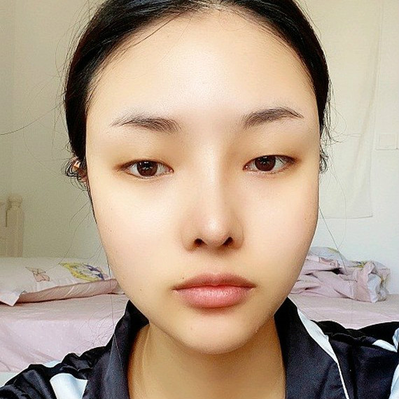 双眼皮手术