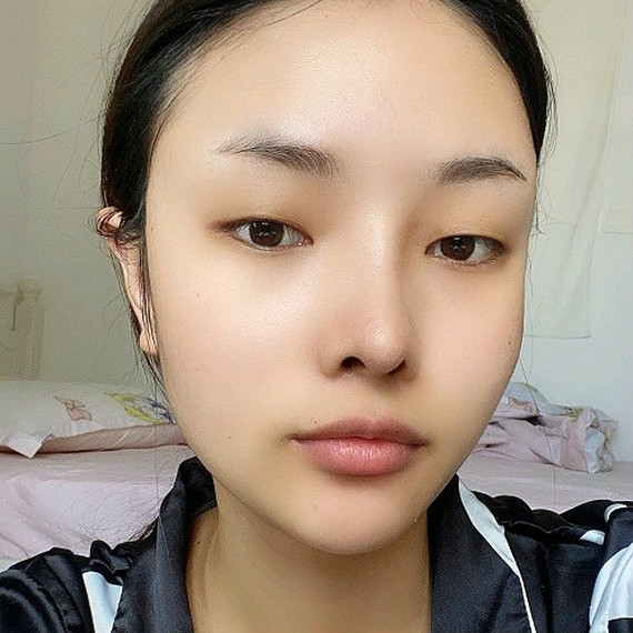 双眼皮手术