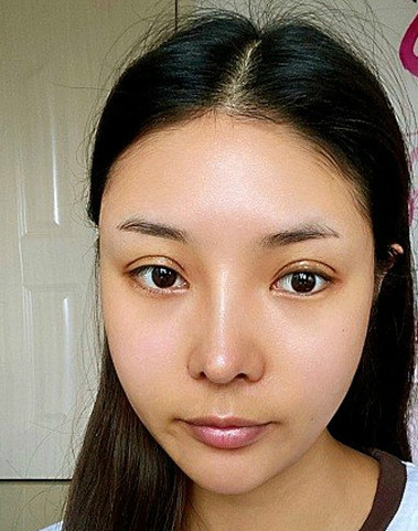 双眼皮手术