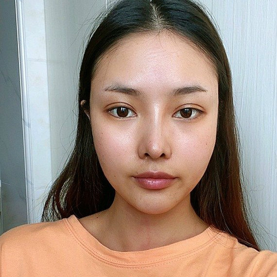 双眼皮手术