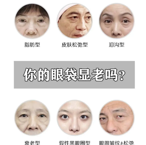 去眼袋手术
