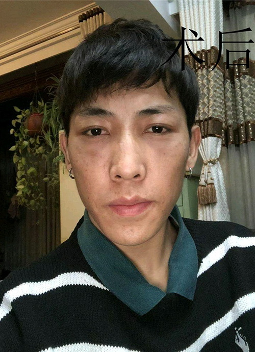 去眼袋手术