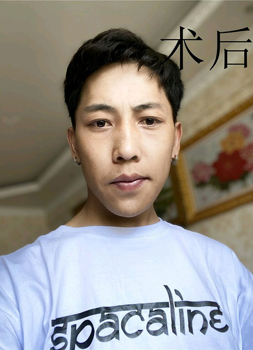 去眼袋手术
