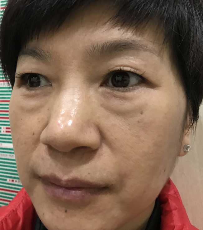 去眼袋手术