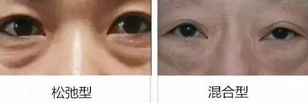 去眼袋手术