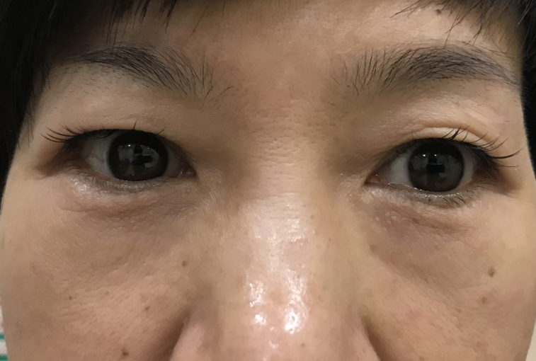 去眼袋手术