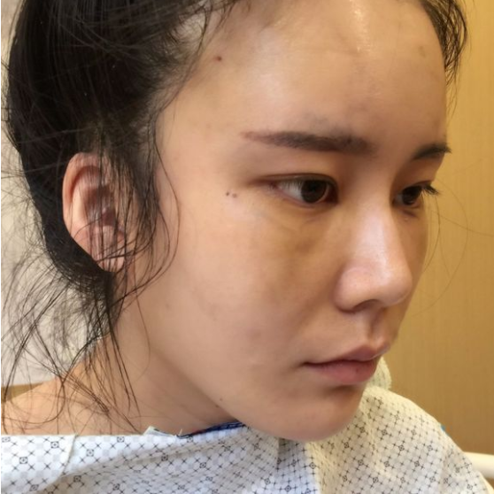 去眼袋手术