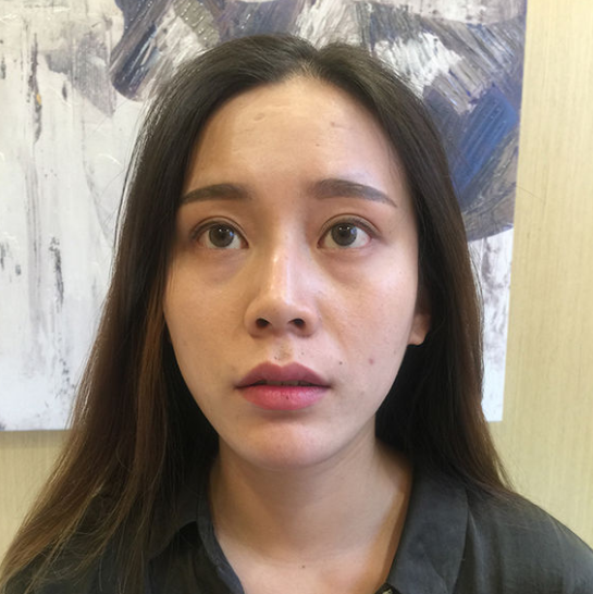 去眼袋手术