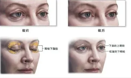 去眼袋手术