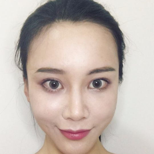 去眼袋手术