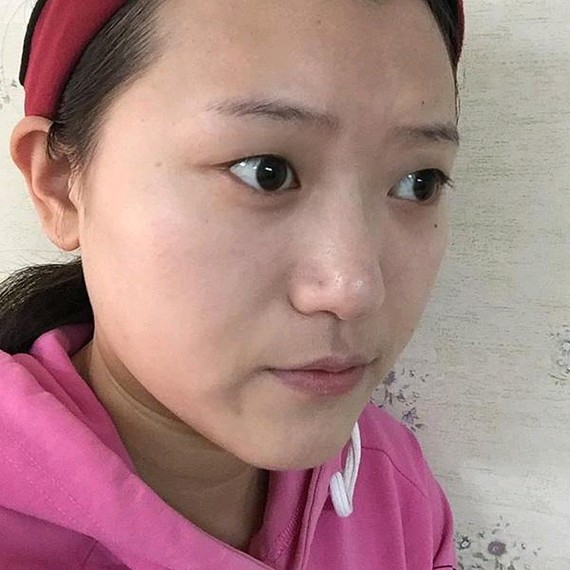 双眼皮手术