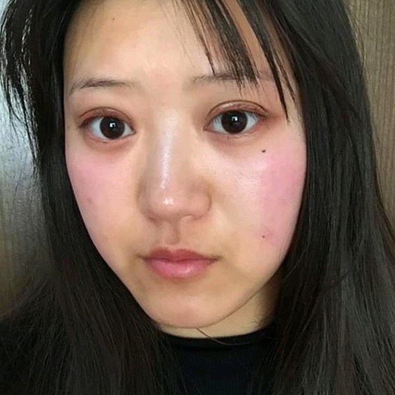 双眼皮手术
