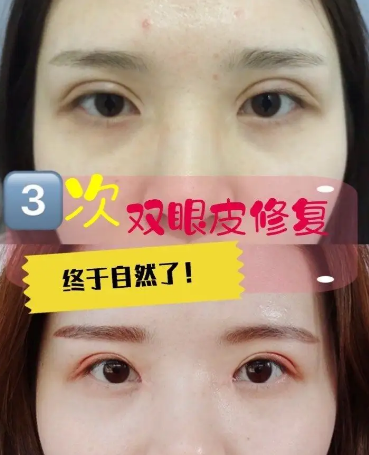 谁也不想做双眼皮手术修复!所以得认真选择术931 谁也不想做双眼皮手术修复!所以得认真选择术931