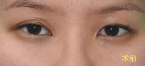 谁也不想做双眼皮手术修复!所以得认真选择术931 谁也不想做双眼皮手术修复!所以得认真选择术931