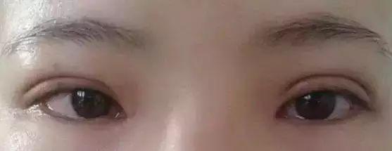 谁也不想做双眼皮手术修复!所以得认真选择术931 谁也不想做双眼皮手术修复!所以得认真选择术931