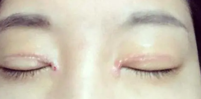 谁也不想做双眼皮手术修复!所以得认真选择术931 谁也不想做双眼皮手术修复!所以得认真选择术931