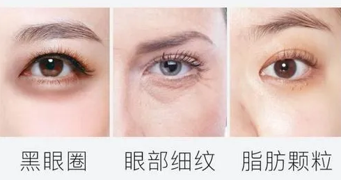 去眼袋手术——20岁长出眼袋真的不着急祛？_1124