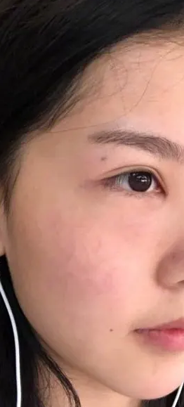 去眼袋手术——20岁长出眼袋真的不着急祛？_1124