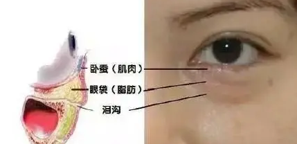 【去眼袋手术】美的眼睛有眼袋?超雅帮你!379 【去眼袋手术】美的眼睛有眼袋?超雅帮你!379
